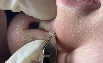 Close-up of a person examining blackheads on their nose in front of a mirror, highlighting common skincare concerns and available treatment options for clearer, healthier-looking skin.
